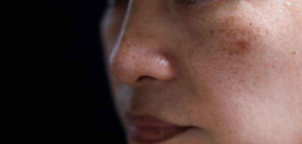 melasma on woman face. isolated on dark background
