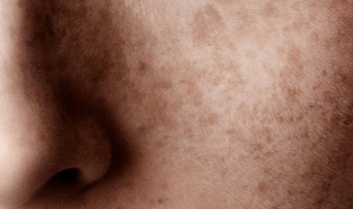 Close-up of facial pigmentation resembling melasma, illustrating a common skin concern addressed in the question: does laser pigmentation removal work