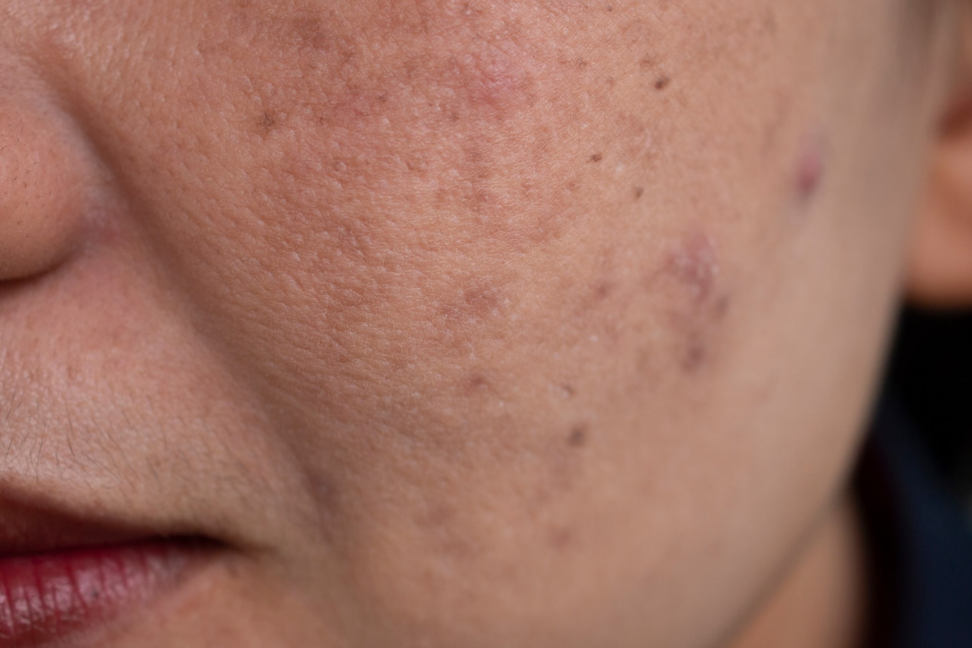 Close-up of a woman's face with melasma and dark spots on cheeks, highlighting the need for the best melasma treatment for face.