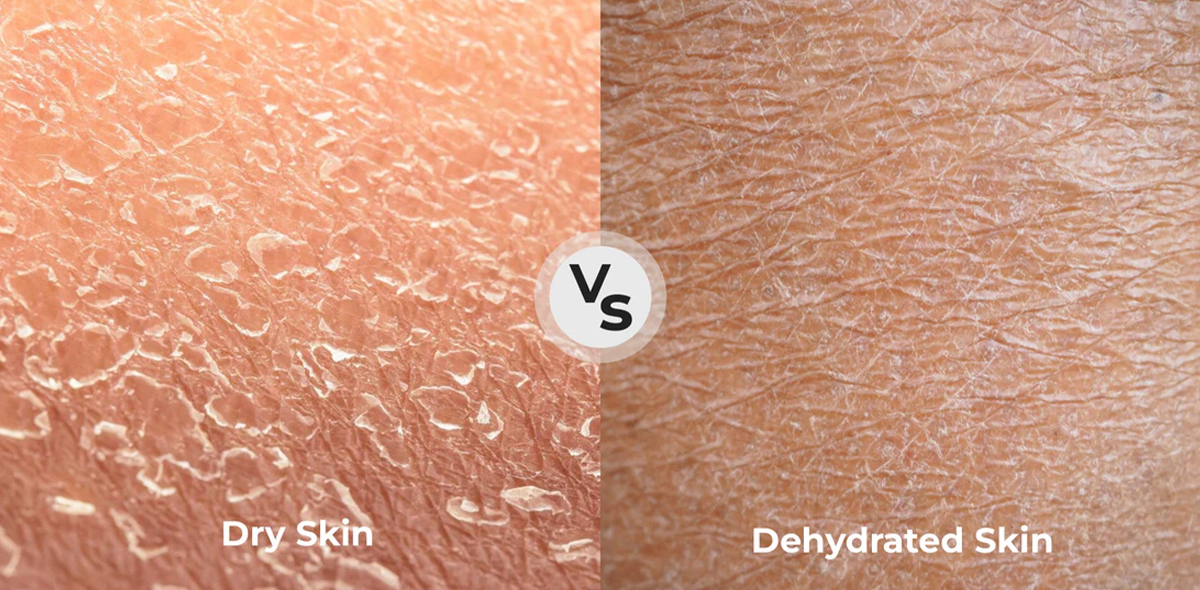 Dehydrated vs. Dry Skin Differences