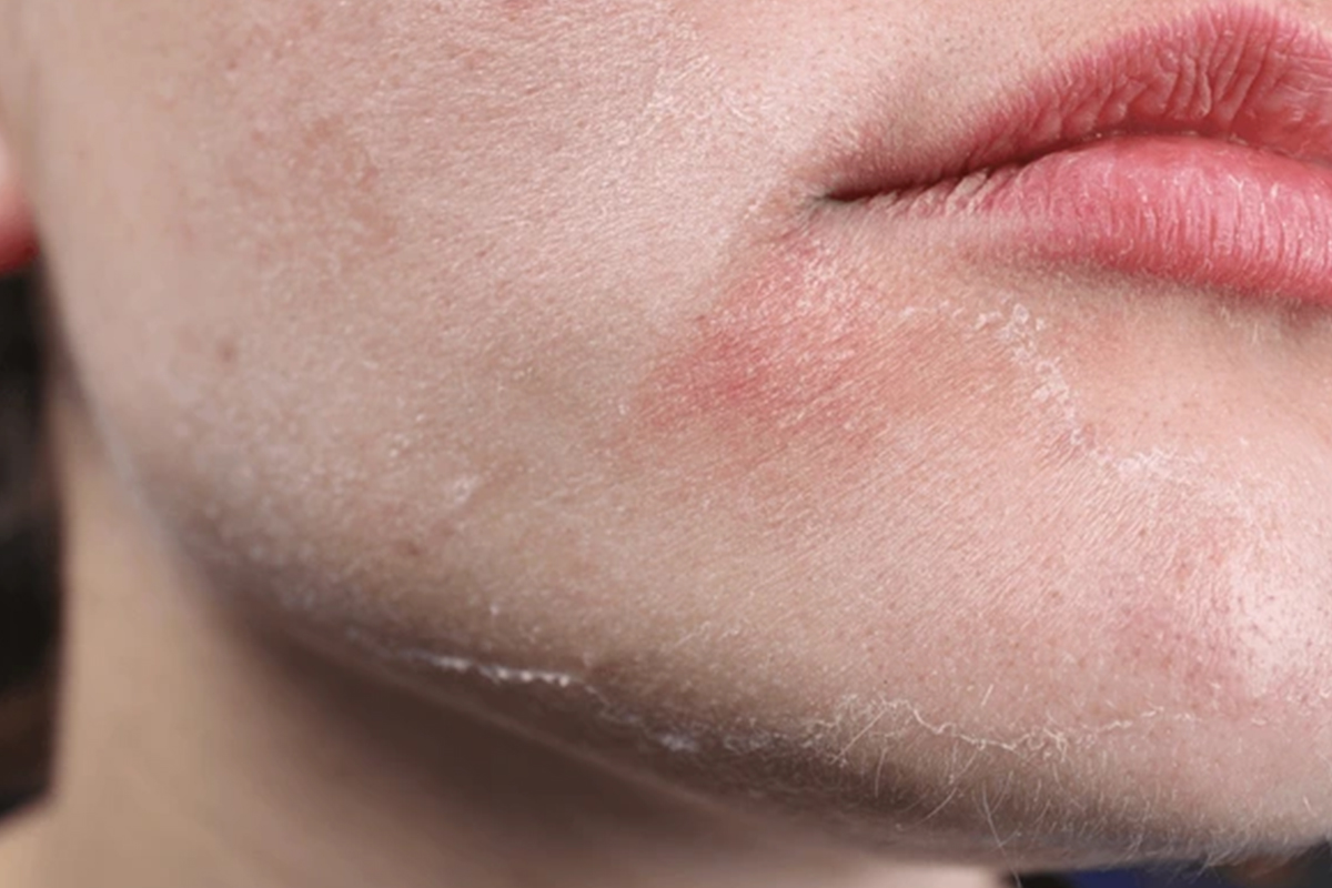 Facial redness visible indicating a sensitive skin.