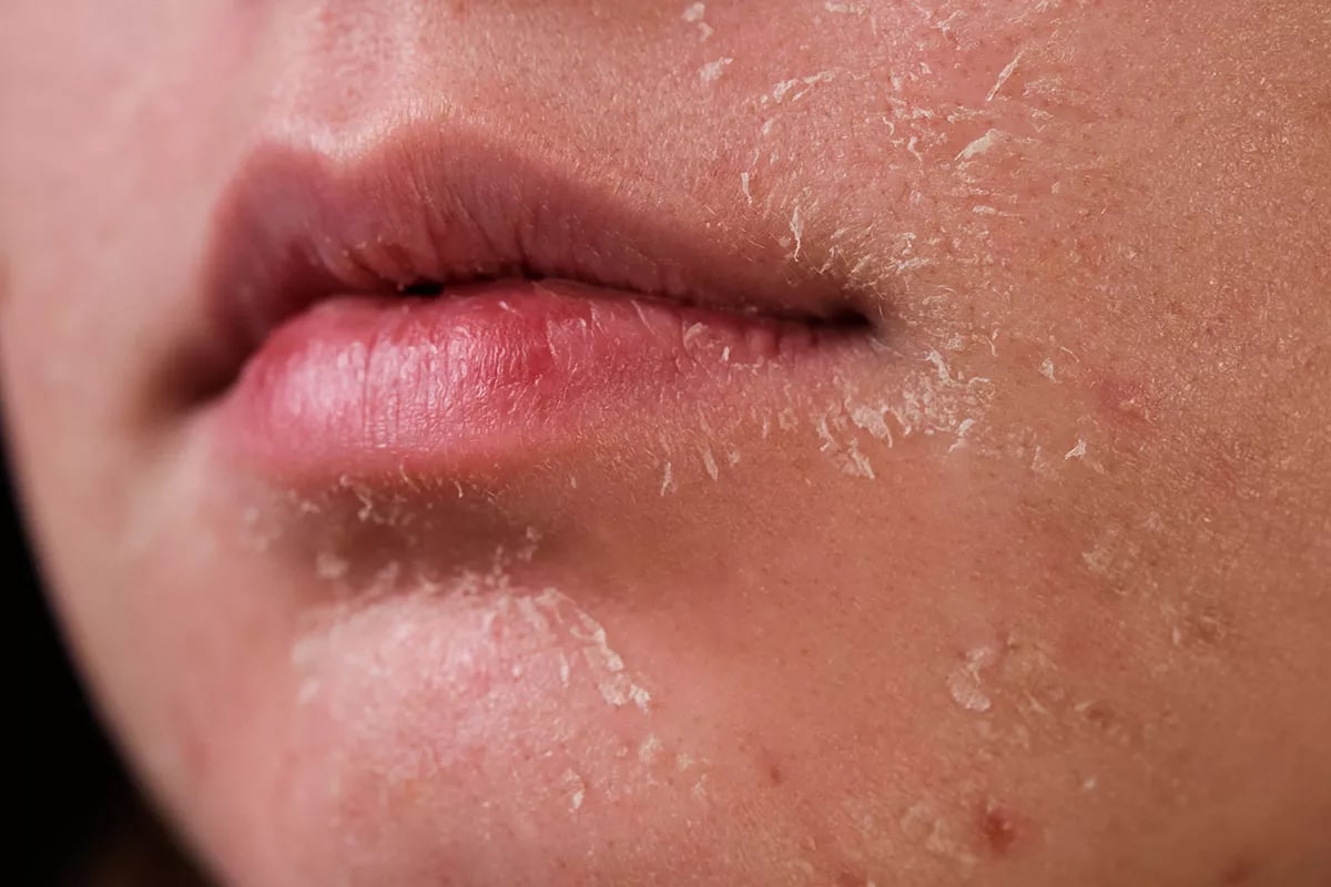 Face with peeling skin showing signs of skin barrier damage