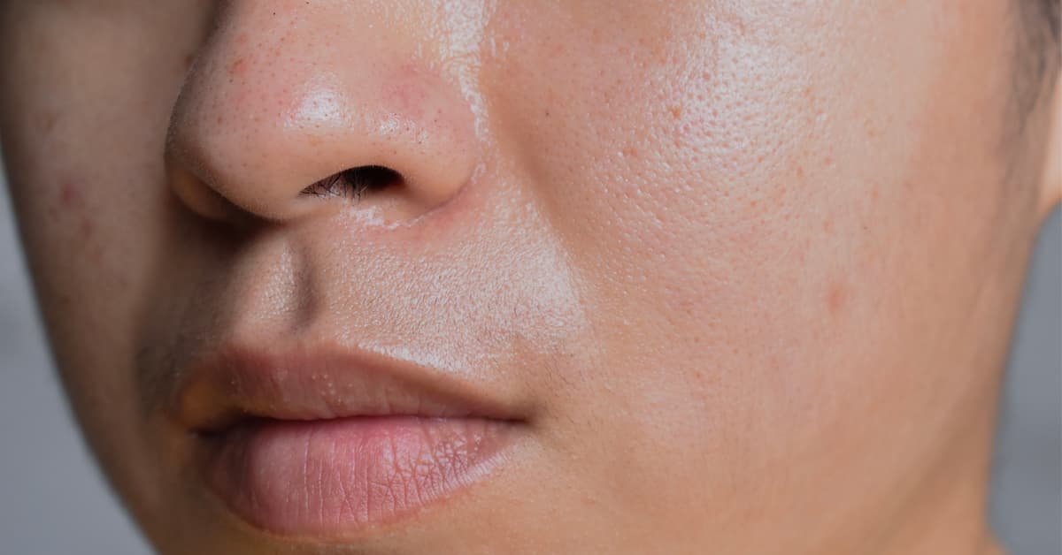 image of a woman's oily and dull skin