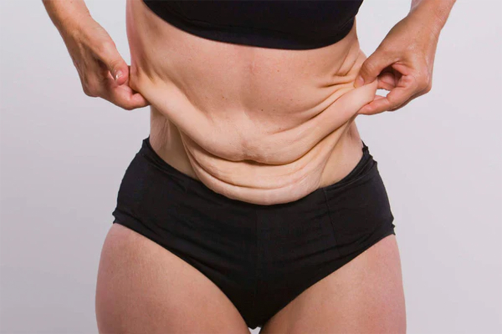 Sagging skin after weight loss