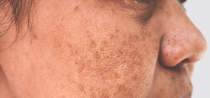 A woman's face with visible pigmentation