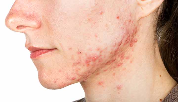 Close-up of a woman's cheek with cystic acne, showing inflamed breakouts—used to illustrate how to treat under-the-skin acne effectively.