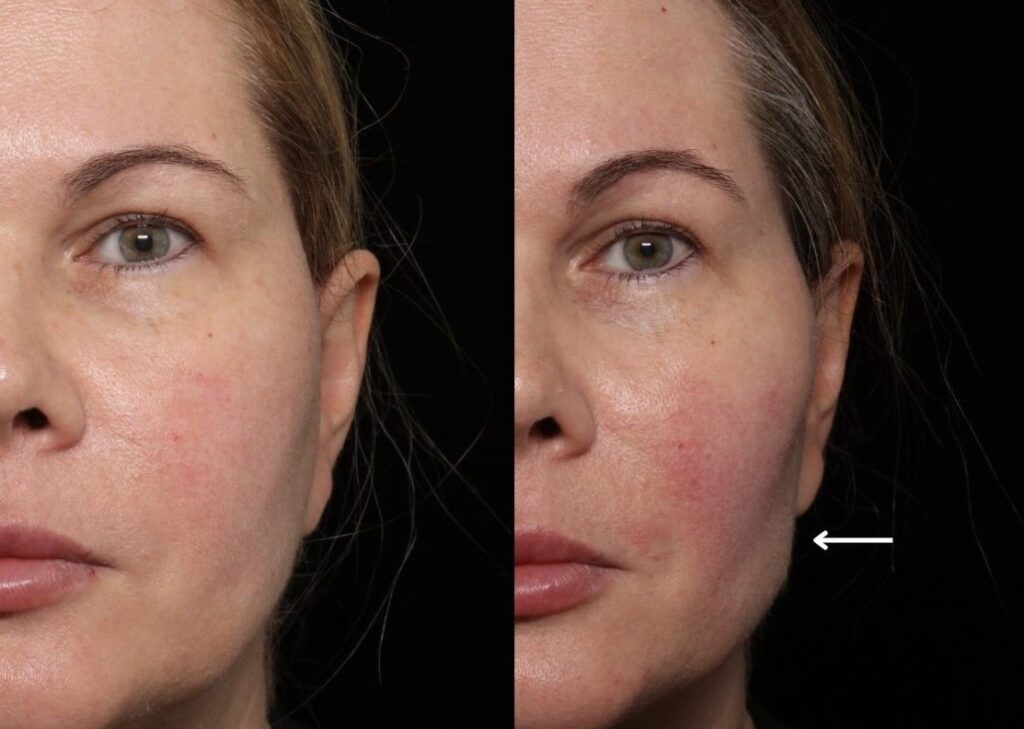 image of full vs. hollow midface