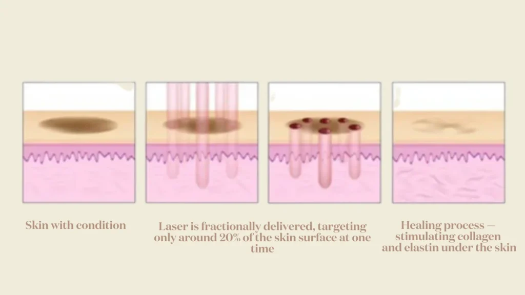 Fractional laser technology creating microscopic treatment zones for targeted skin resurfacing.