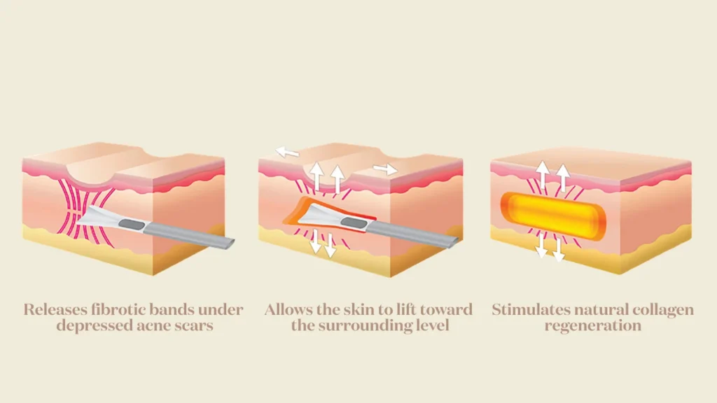 Medical diagram of the subcision process showing the mechanical release of fibrotic scar tethers.