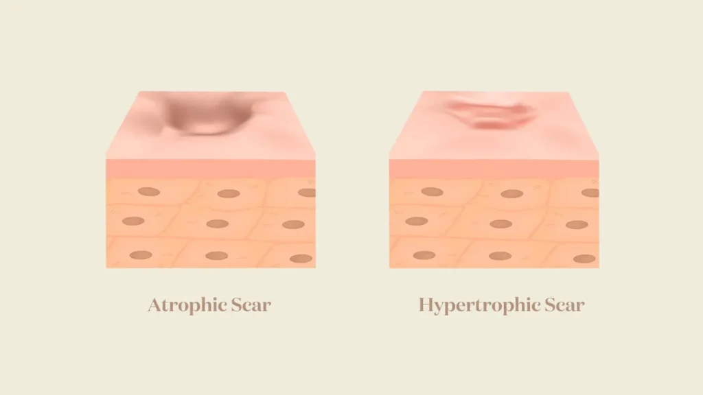 Atrophic Scar and Hypertrophic Scar illustrations