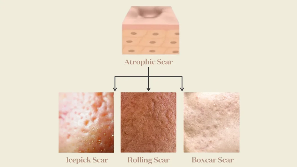 Atrophic Scar types