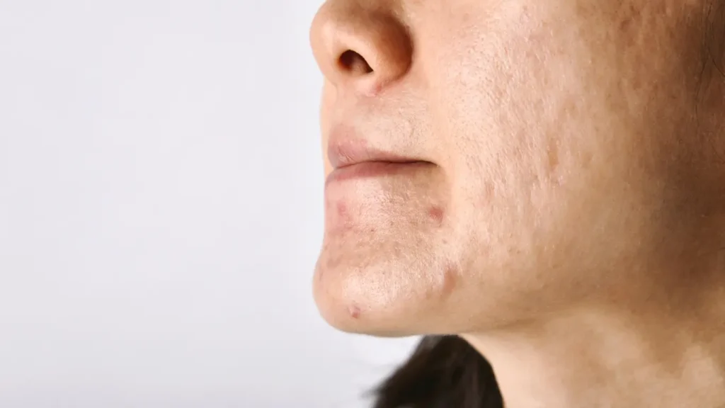 Close-up of atrophic acne scars on the cheek and chin showing different types of pitting.