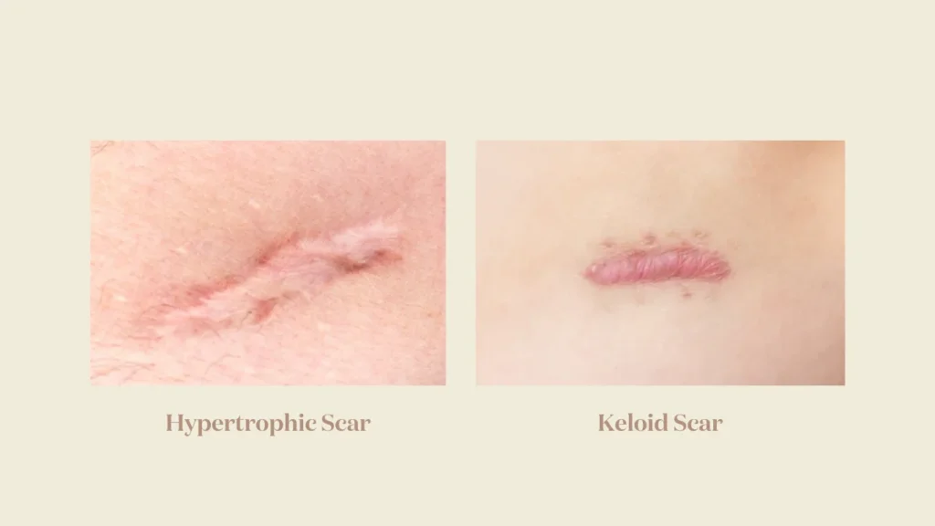 Hypertrophic Scar and Keloid Scar pictures