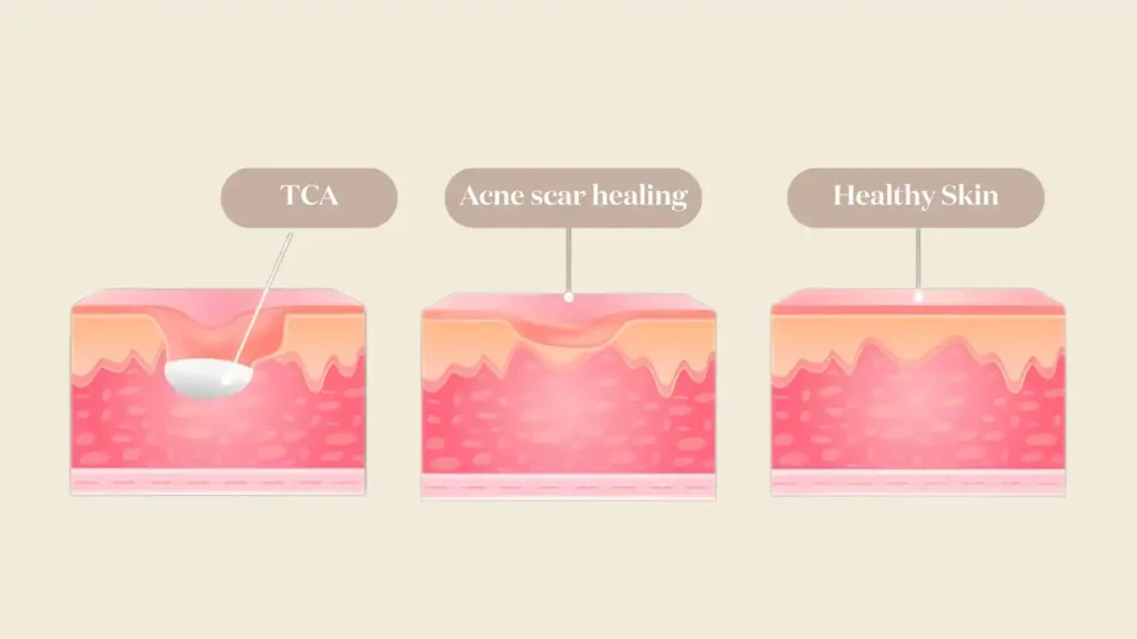 Illustration showing the precise application of trichloroacetic acid into a deep ice-pick scar to trigger localized reconstruction.