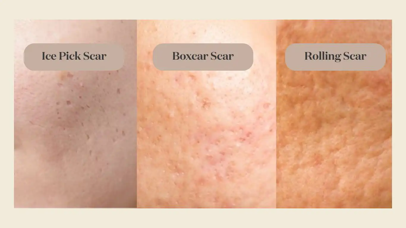 Macro photography showing the visual characteristics of ice pick, boxcar, and rolling acne scars on the skin.