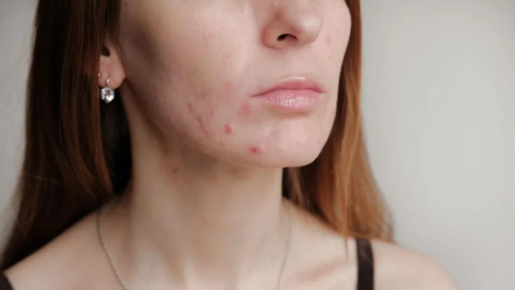 Woman with Post-Inflammatory Erythema