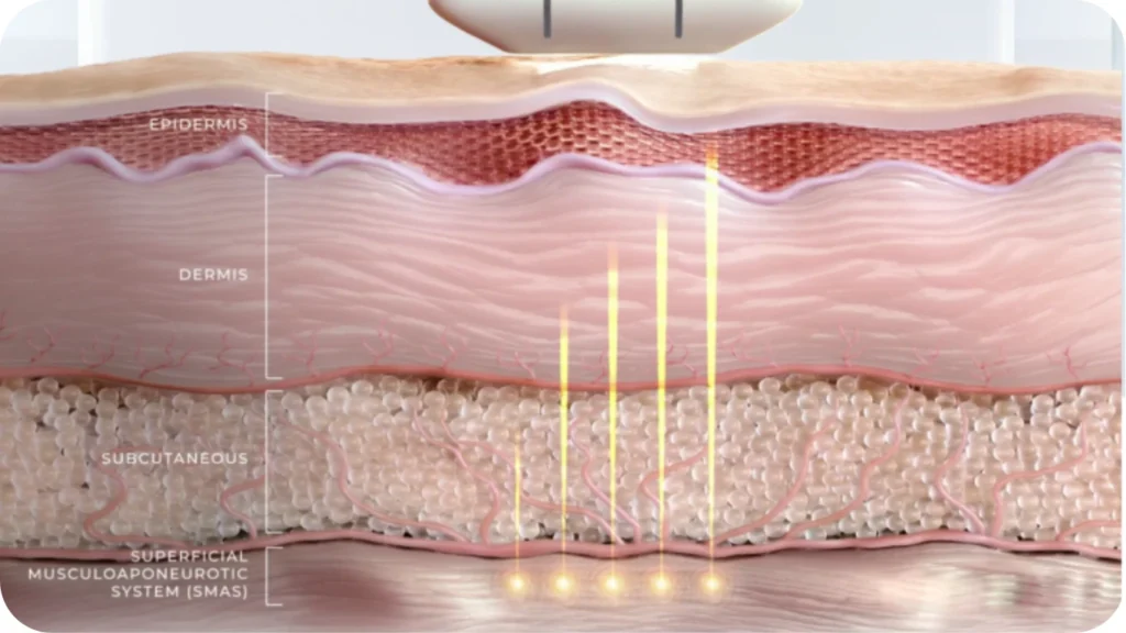 Diagram of focused ultrasound energy bypasses the surface to create precise thermal points at depths of 1.5mm, 3.0mm, and 4.5mm.