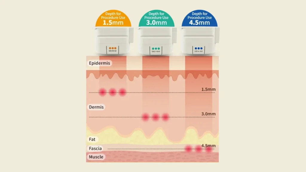 Cross-section showing the development of stronger collagen and visible skin lifting from month 1 to month 6 post-treatment.