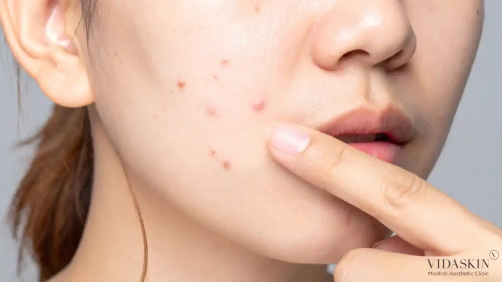 Asian female patient pointing to active inflammatory acne lesions on the lower cheek and jawline.