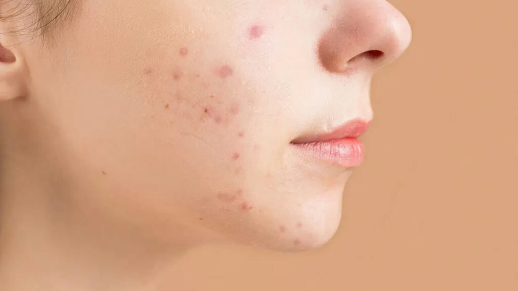 Close-up of skin post-inflammation, emphasizing the importance of heat management to prevent post-inflammatory hyperpigmentation.