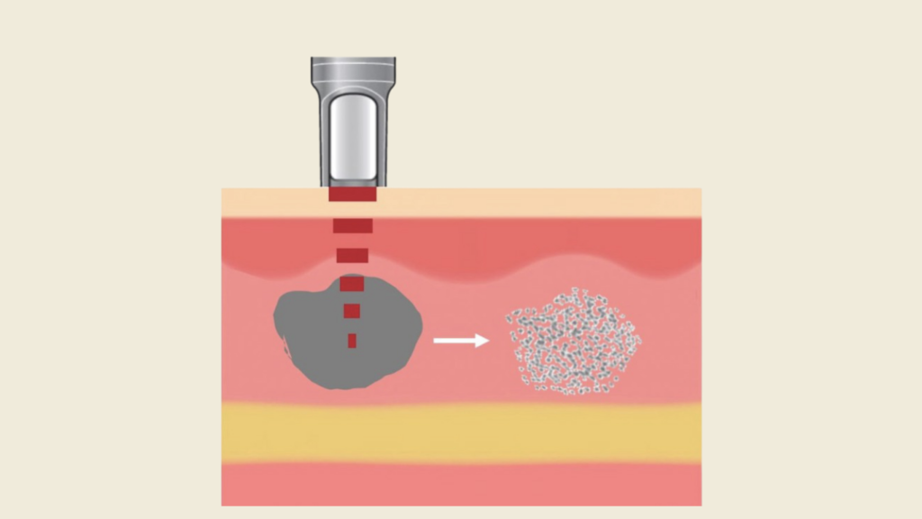 Diagram showing low-fluence laser toning using gradual energy delivery to regulate melanocyte activity without surface damage.
