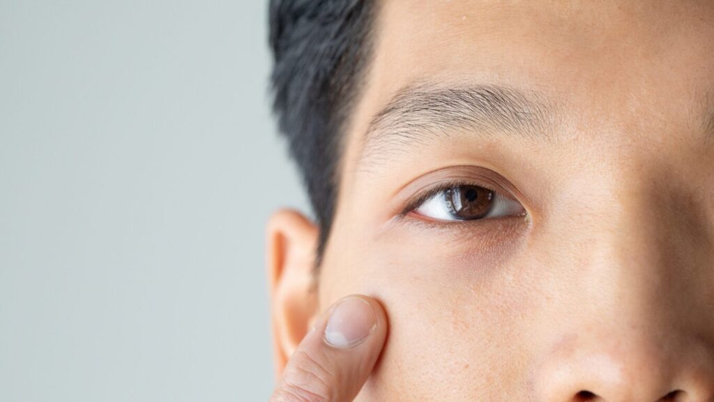 Close-up of the periocular area showing under-eye pigmentation and volume loss being assessed for brightening therapy.