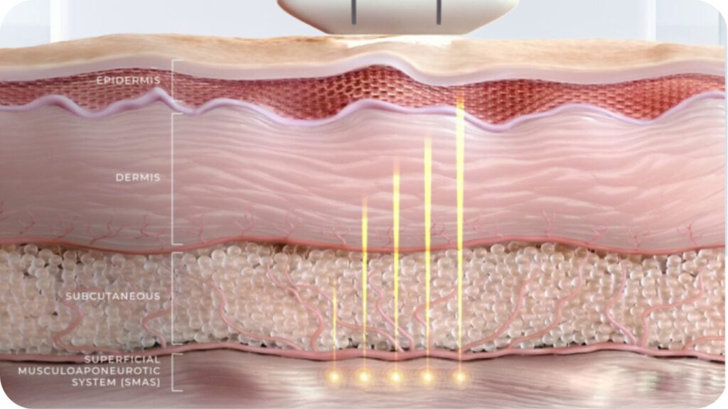Diagram showing micro-focused ultrasound energy penetrating through the epidermis and dermis to reach the foundational SMAS layer for tissue support.