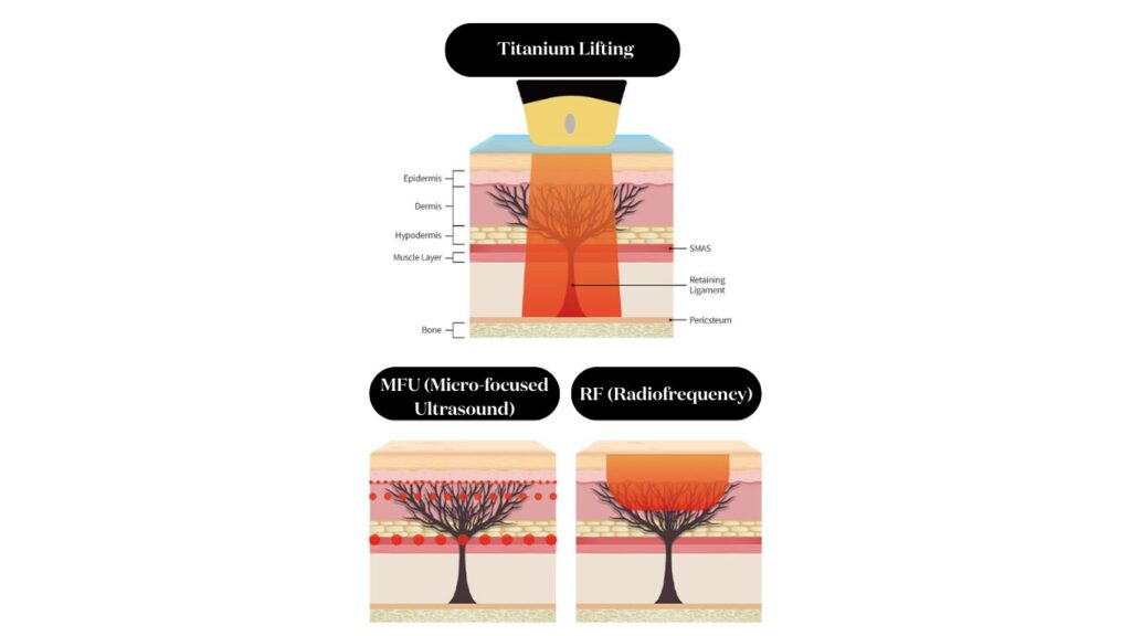 Comparison of Titanium Lifting's depth alongside Micro-focused Ultrasound (MFU) and Radiofrequency (RF) technologies.