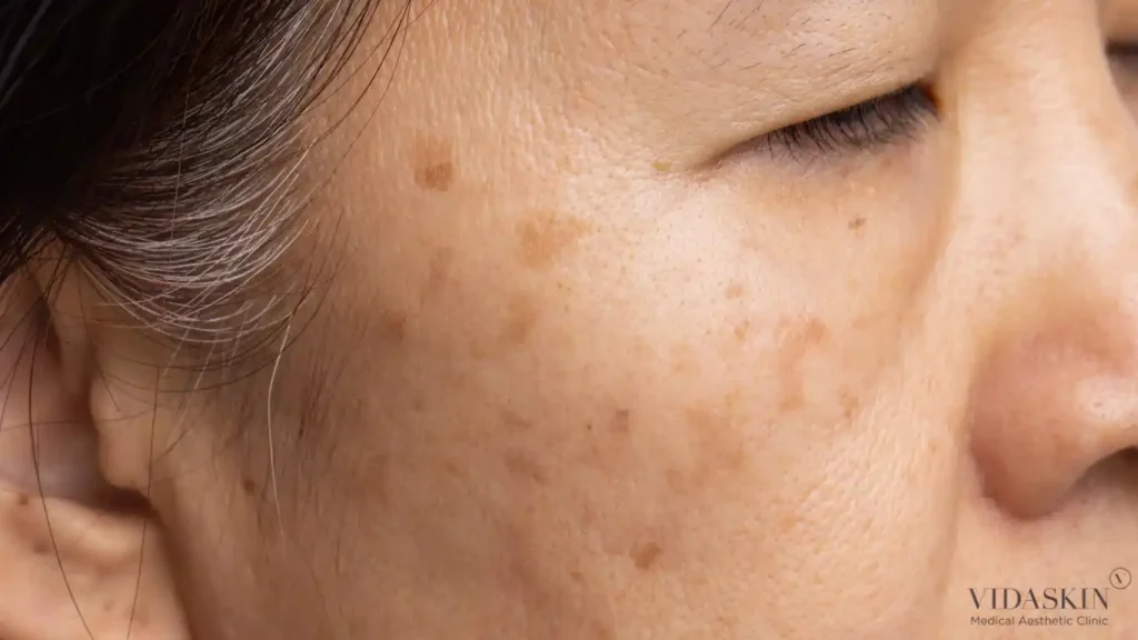 Close-up clinical presentation of symmetrical melasma patches on an Asian patient's cheek.