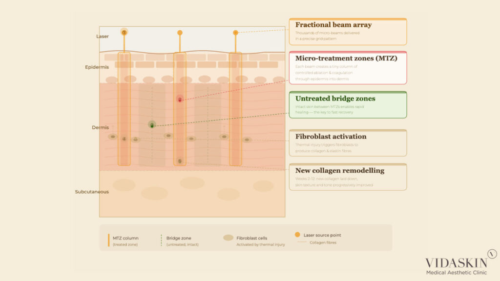 Diagram of fractional laser micro-treatment zones (MTZ) stimulating fibroblast activation in the dermis.