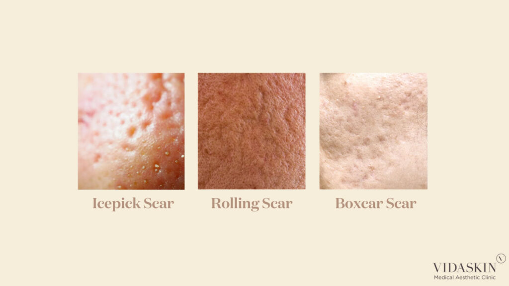 Visual classification of three primary acne scar types: Icepick, Rolling, and Boxcar scars.
