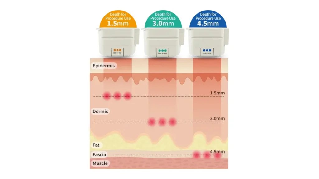 Visualization of the three depths targeted by Ultherapy transducers to reach the SMAS and dermal layers.