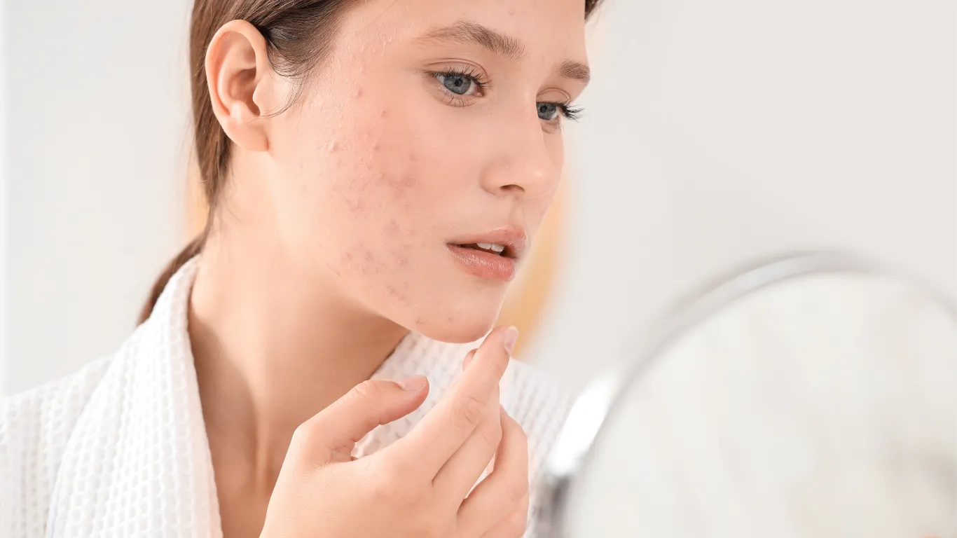 Acne Scar Treatment Singapore: Your Complete Guide