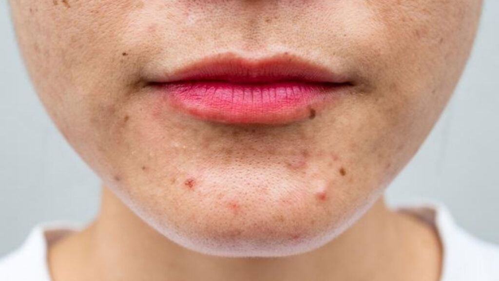 Acne on the chin of a patient