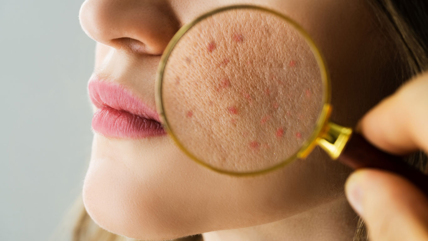 Acne-seen-under-a-magnifying-glass