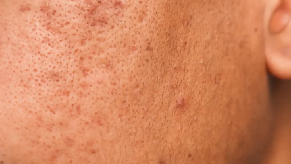 Close-up of a face with acne scars