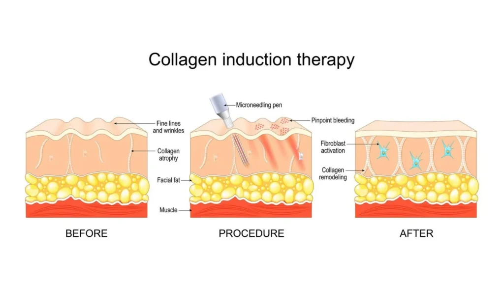 Collagen induction therapy