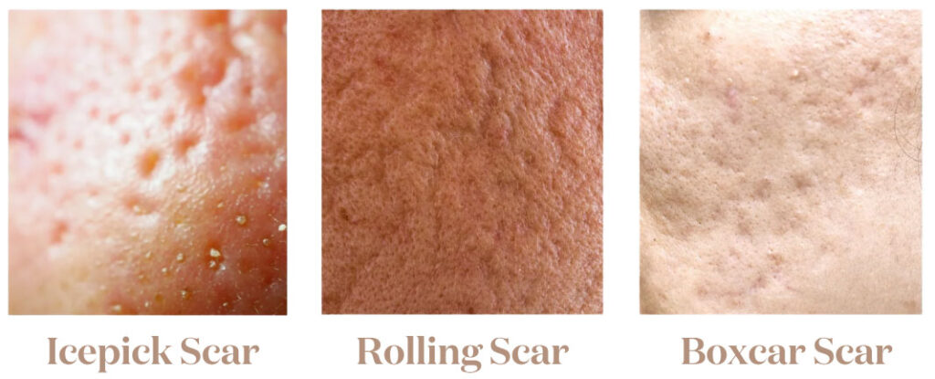 Common types of acne scars