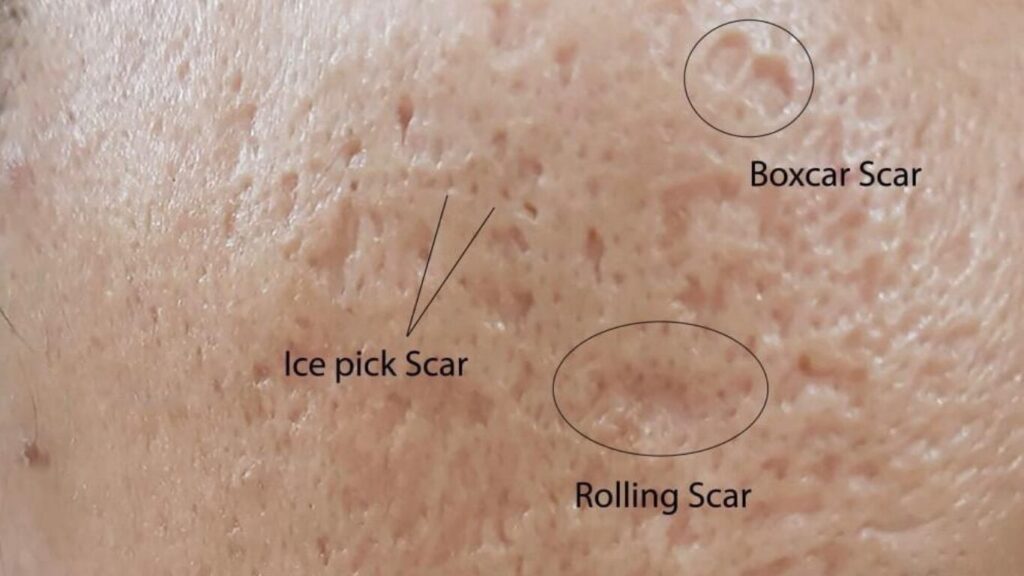 Different types of acne scars