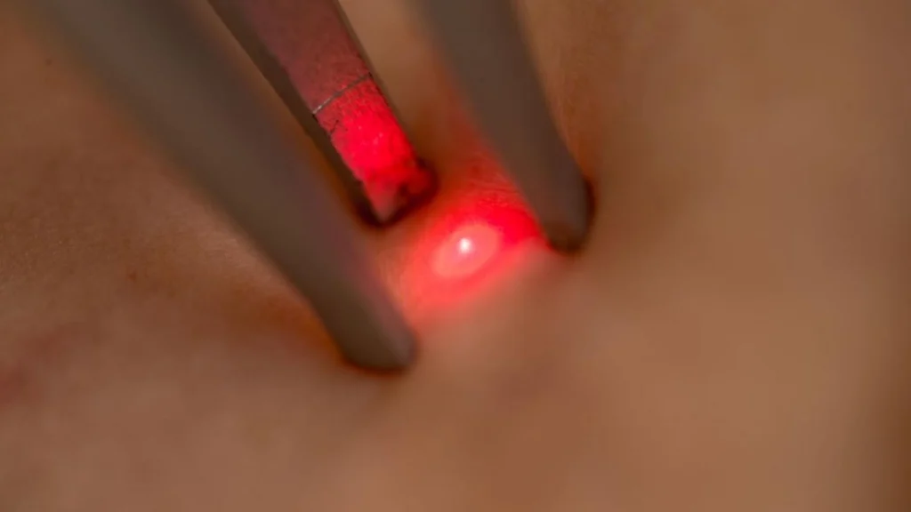 Fractional laser on the skin