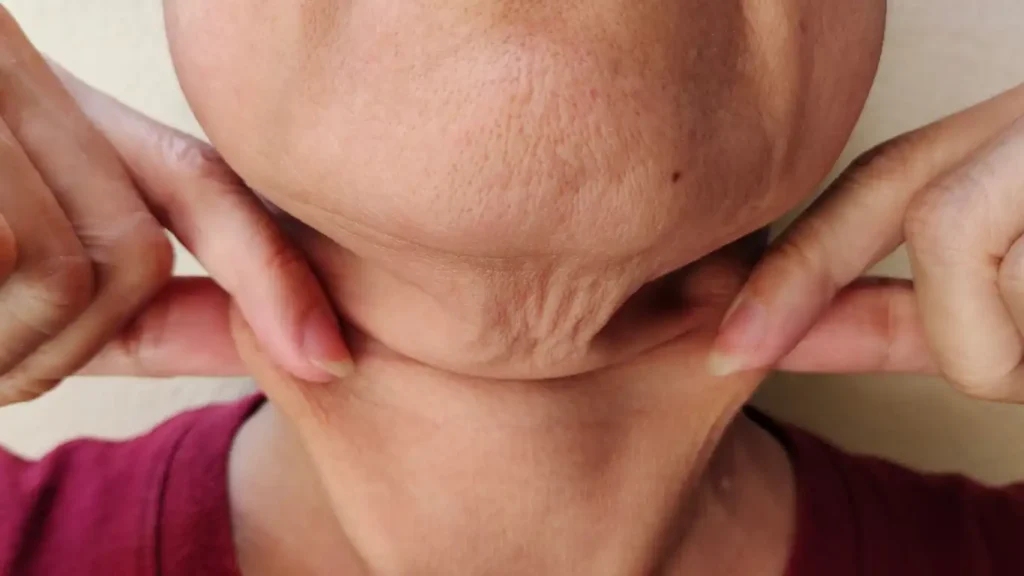 Person with sagging skin on the neck