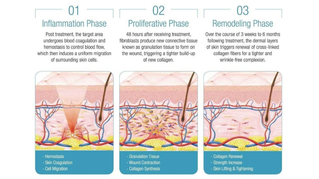 Skin texture improving in phases