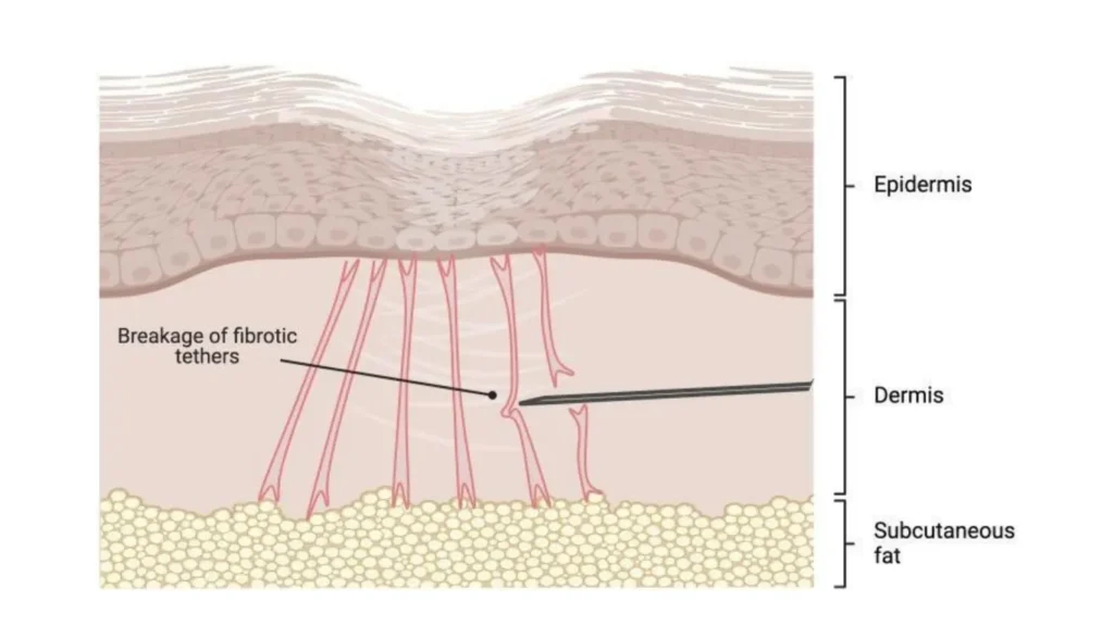Subcision illustration