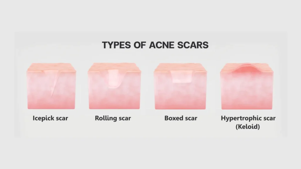 Types of acne scars