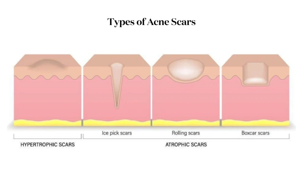 Types of acne scars