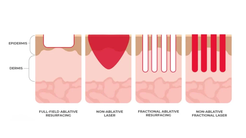 Various Scar Types
