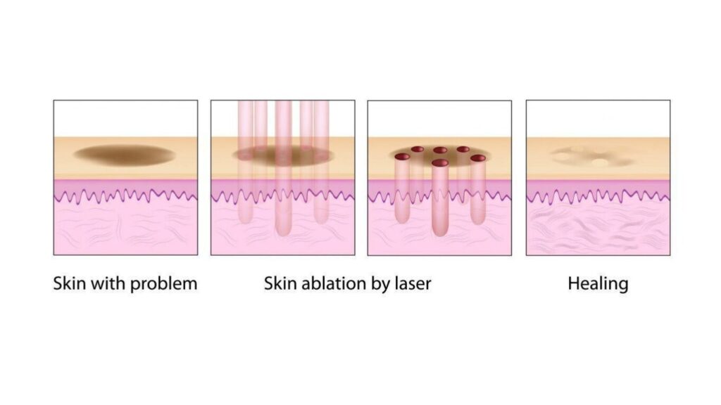 Collagen remodelling