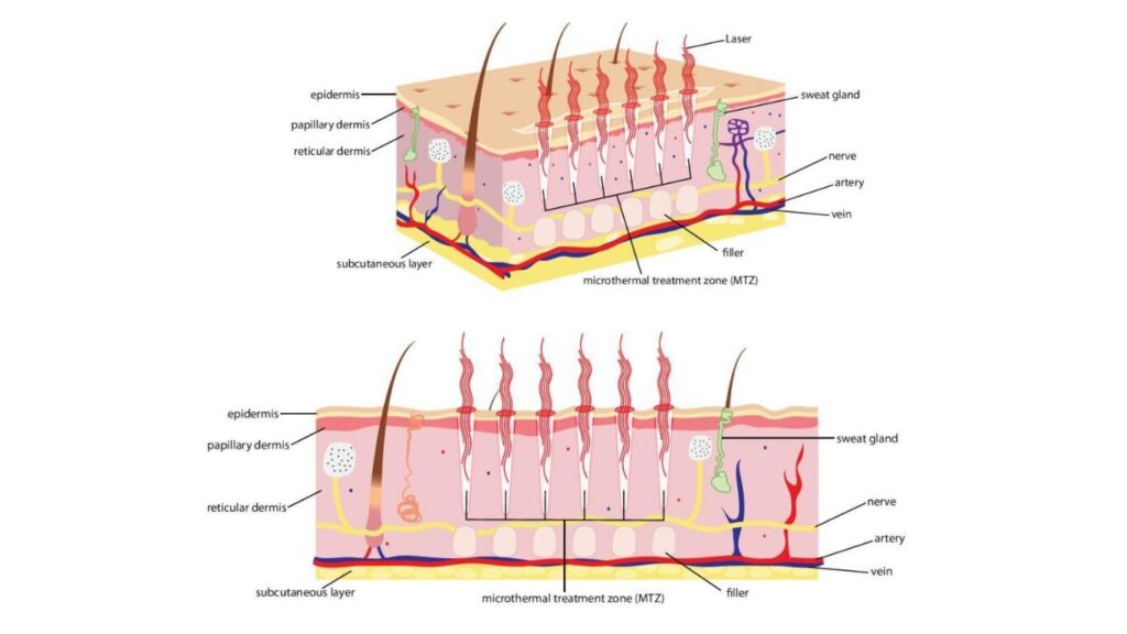 How Fractional C02 laser works