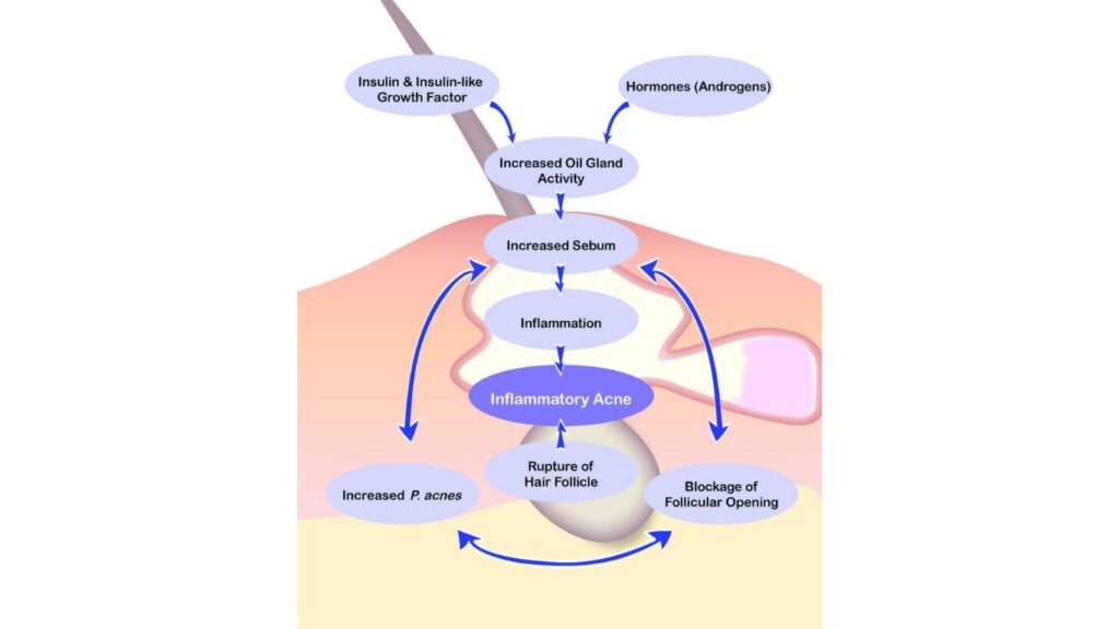 How inflammation leads to cysts