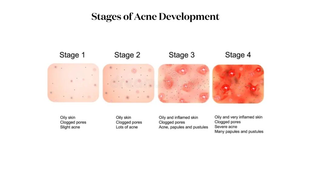 Stages of Acne Development